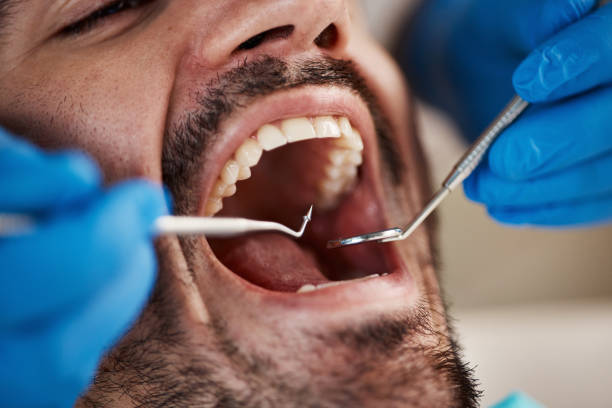 Best Emergency Tooth Extraction in Richmond, TX